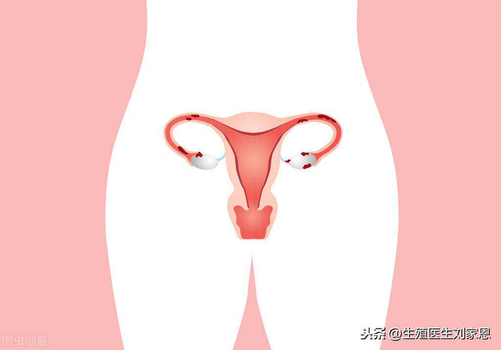 香港验血孕检报告单是什么样,子宫内膜异位症做试管婴儿要注意什么？